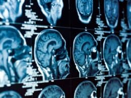 Properly Handling Mental Cases in Workers' Compensation