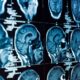 Properly Handling Mental Cases in Workers' Compensation