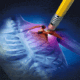 chronic-pain in workers compensation